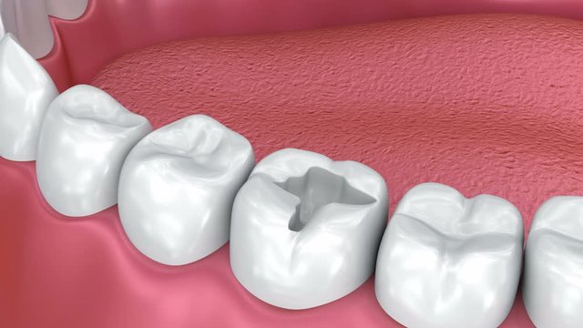 Ceramic dental fillings, Medically accurate 3d animation