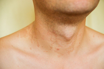 Fototapeta premium dermatitis skin