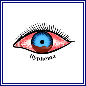 Hyphema - hemorrhage in the anterior chamber of the eye.