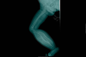 X-ray of infantile cortical hyperostosis
