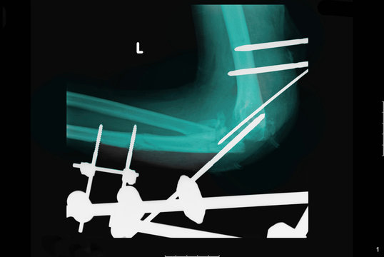 X-ray showing metal fixtures