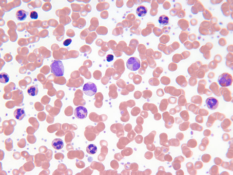 Close up of myelogenous leukemia