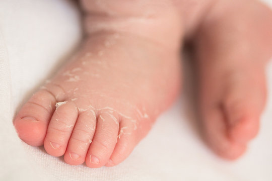 legs of a newborn with peeling skin on a white background closeup