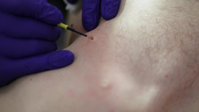 Doctor removing mole in surgical procedure.