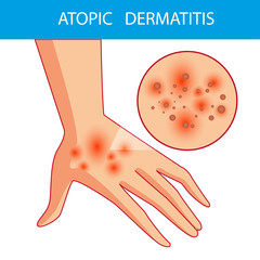atopic dermatis. The person scratches the arm on which is atopic dermatitis. Itching. Colored vector illustration of a skin lesion, itchy skin.
