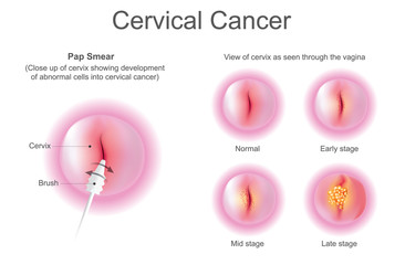 Stage of Cervical cancer. Education info graphic vector.