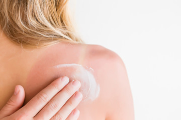 On woman's back skin smears cream after sun burn.