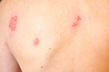 Fototapeta premium Shingles on men herpes zoster. Closeup.
