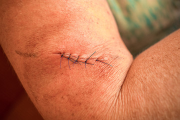 Stitched scar on hands. Closeup.