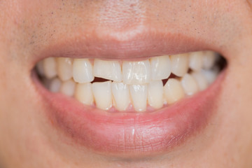 closeup mouth dental problem. Teeth Injuries or Teeth Breaking in Male. Trauma and Nerve Damage of...