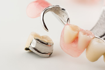 Clasp prosthesis with lock fixation