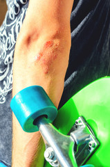 Closeup of a young caucasian man with a skate board in his hand. Injuries in extreme sports. Traumatic extreme sports concept