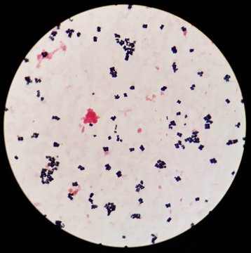 Smear of human blood cultured Gram's stained with gram positive cocci in cluster bacteria, under 100X light microscope and selective focus.