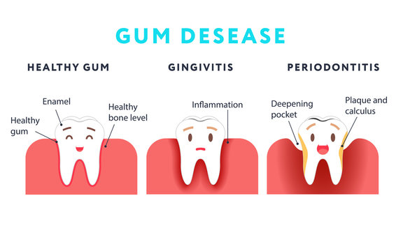 Step of gum disease. Healthy tooth and gingivitis.. Cute cartoon design, illustration isolated on blue background.