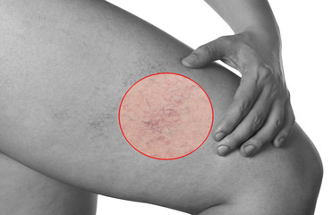Man shows hand seat with the dilation of small blood vessels of the skin on the leg. Medical...