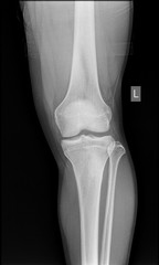 Normal x-rays of human knee front view