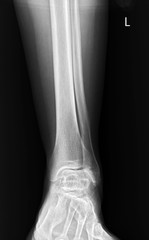 x-ray of human leg and ankle