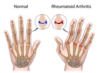 Rheumatoid arthritis of hand - obrazy, fototapety, plakaty