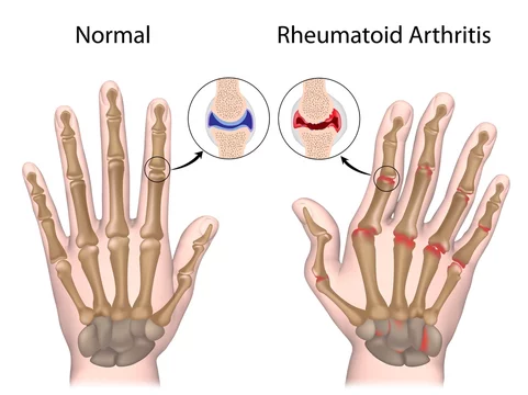 a kezek ízületeinek rheumatoid arthritis)