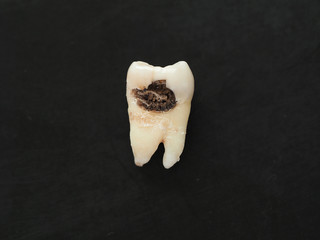 Closeup single bad tooth with caries big hole on black background. Unhealthy teeth.