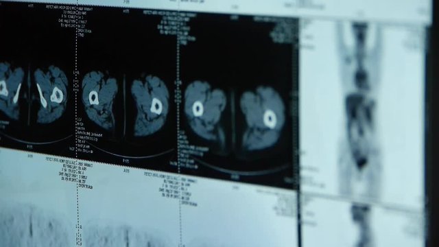 human orage & bone pet-ct scan,X-ray,Cancer metastasis.