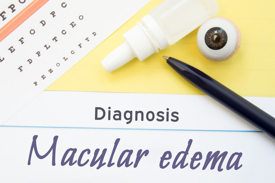 Chart For Testing Visual Acuity, Eye Drops And Anatomical Model Lies Next To Inscription Diagnosis Macular Edema. Concept For Diagnosis, Treatment And Prevention Of Ophthalmic Disease Macular Edema 