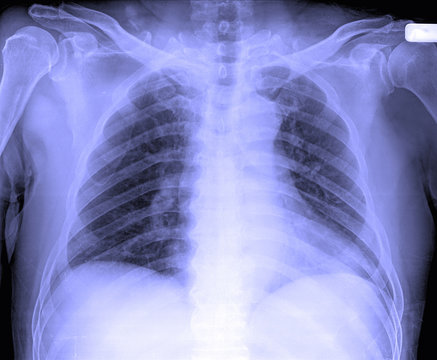 X-Ray image of male human chest