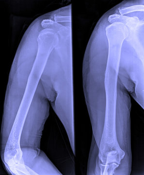 X-Ray image of male shoulder and joints