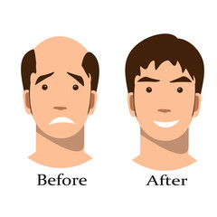 Men thinning hair treatment before and after