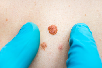 Woman with birthmark on her back, skin tags removal