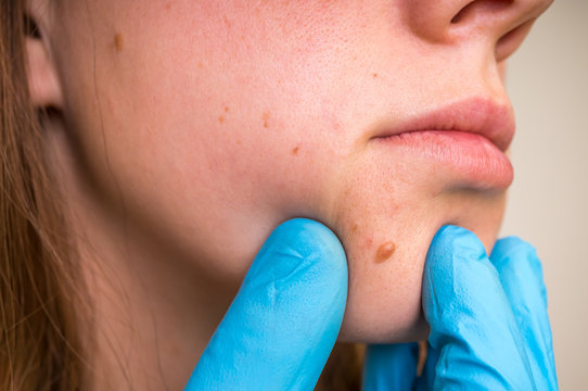 Woman with birthmark on her face, skin tags removal