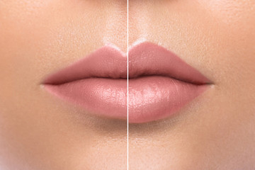 Comparison of female lips after augmentation - obrazy, fototapety, plakaty