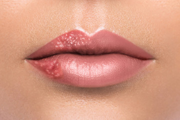 Fototapeta premium Female lips affected by herpes virus
