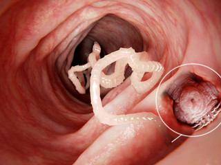 Bandwurm in menschlichen Darm.Vergrößerung des Kopfes, daß an der Darmwand verankert ist.