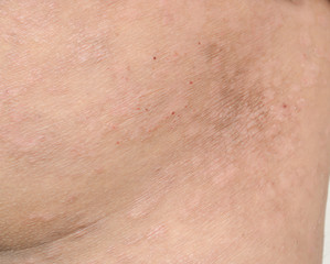 Fototapeta premium Psoriasis on the skin