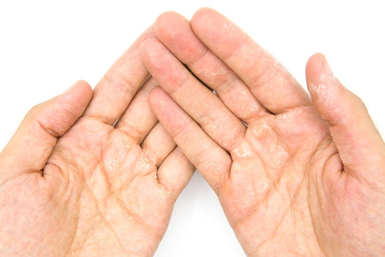 Male Hands Close Up, Dry Skin