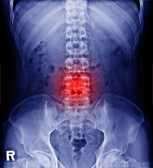 Film x-ray intervertebral lumbar spine  and pelvis of Man