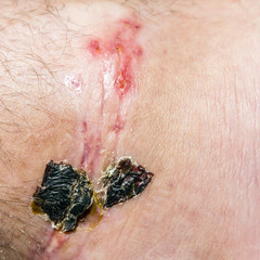 Scar and scab (eschar) on the leg.