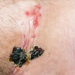 Tuinposter Scar and scab (eschar) on the leg. © gubernat
