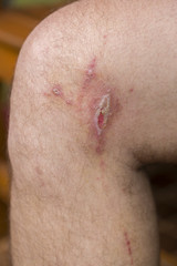 Irritant contact dermatitis at man leg, close up.