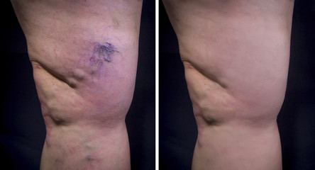 Naklejka premium Human leg with varicose veins