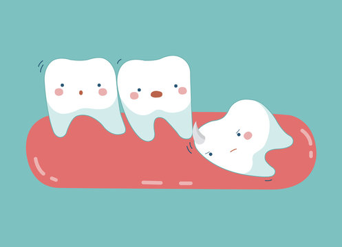 Wisdom tooth push other tooth ,teeth and tooth concept of dental 