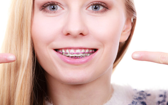 Happy woman showing her braces on teeth