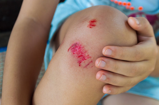 Fresh wound on asian girl knee