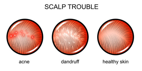troubled scalp. dermatology