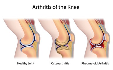 Common types of arthritis of the knee joint - obrazy, fototapety, plakaty