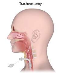 Tracheostomy procedure