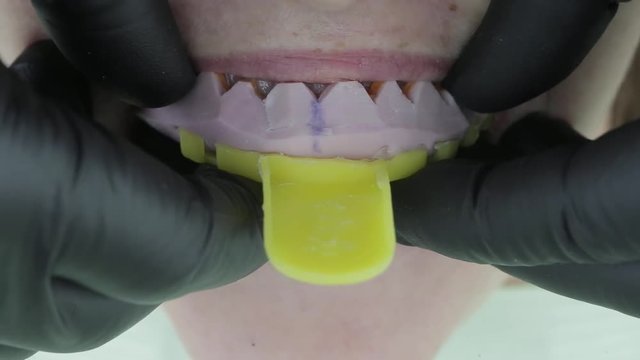 Patient's temporary installation of slips before veneers in dental clinic. Cosmetic dentistry is the veneers