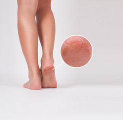 Cracked skin on the heels of female feet