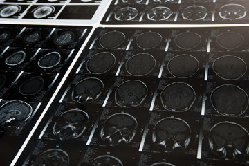MRI scans